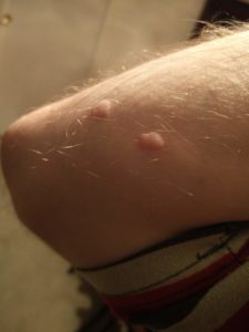 My arm showing lumps from the ringworm infection