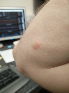 A lump on my arm from the ringworm infection